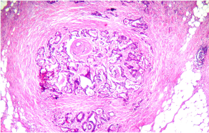 Metastasi linfonodale - nodulo neoplastico