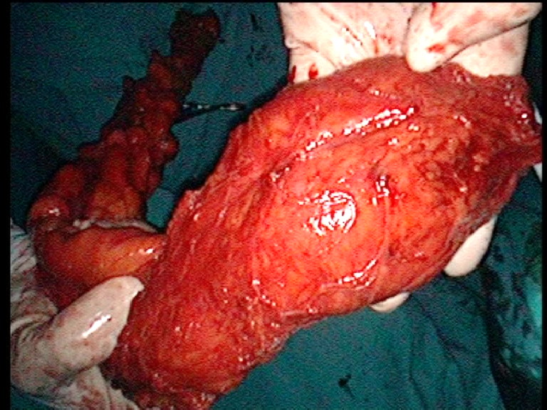 tumore colon - retto