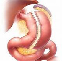 schema sleeve gastrectomy