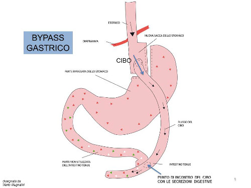 schema bypass gastrico