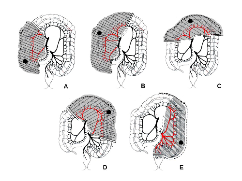 tecniche di intervento per linfadenectomia